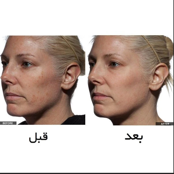 لیزر جوانسازی تریا 2024 (ساخت آمریکا) اصلی - Image 7
