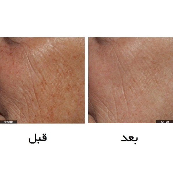 لیزر جوانسازی تریا 2024 (ساخت آمریکا) اصلی - Image 6