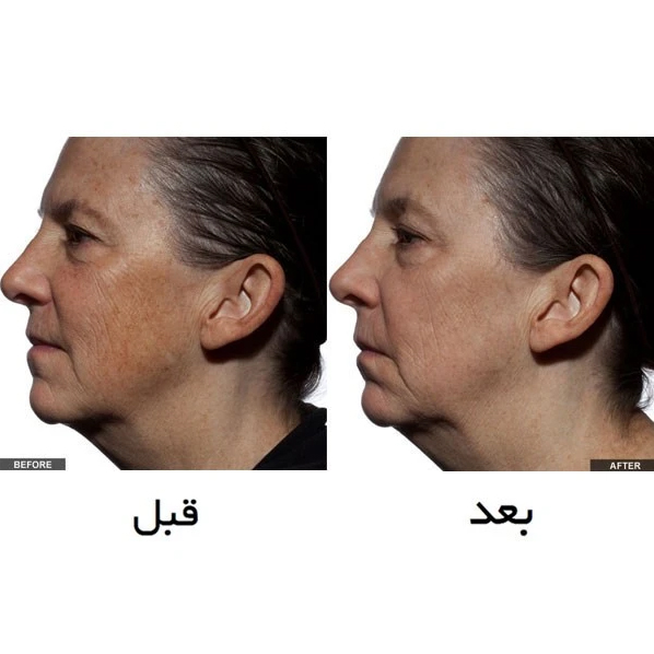 لیزر جوانسازی تریا 2024 (ساخت آمریکا) اصلی - Image 5