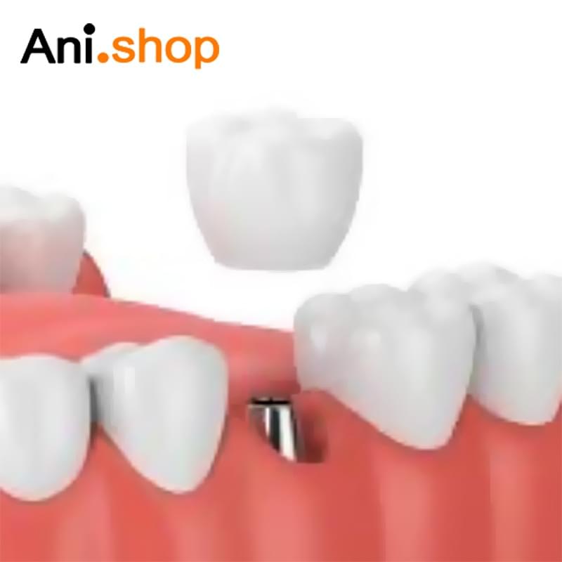 چسب ترکیبی روکش ایمپلنت دندان 4 میل برند هیوج